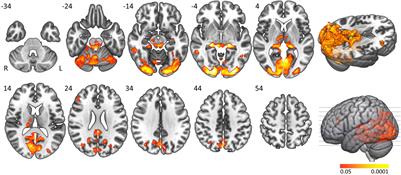 Enhanced Visual Cortex Activation in People With Narcolepsy Type 1 During Active Sleep Resistance: An fMRI-EEG Study